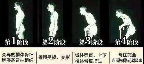 怀孕如何避免强直性脊柱炎,免疫修复治强直性脊柱炎