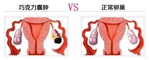 卵巢囊肿手术恢复图片,卵巢囊肿手术