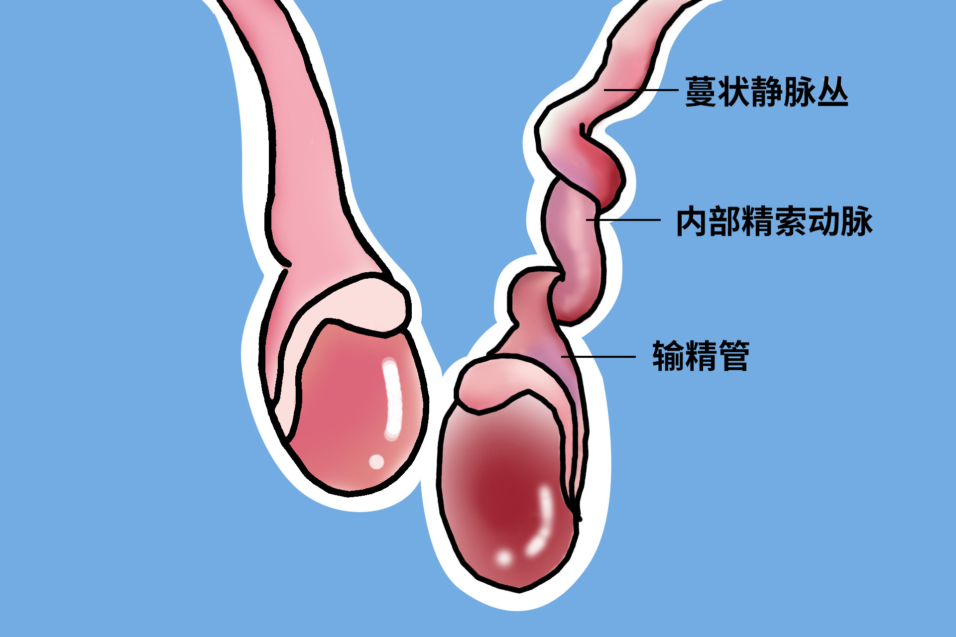 青春期睾丸炎症怎么办,青春期睾丸扭转是剧烈疼痛吗