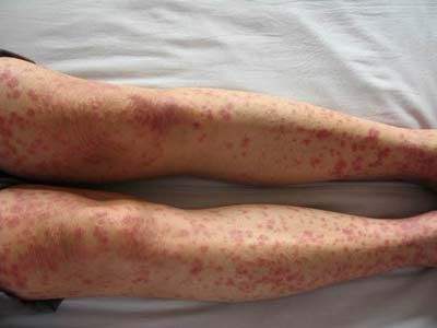 孩子手老是反复脱皮,小孩老是手脱皮什么引起的