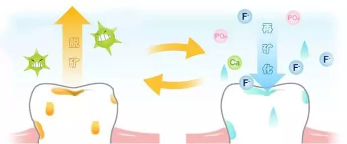 牙齿脱矿涂氟多久可以恢复,牙齿脱矿白斑能自己恢复吗