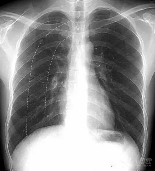 正常胸片图片,正常的胸片讲解