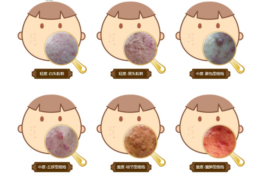 快30了还是长痘,30多岁的男人还长痘怎么回事