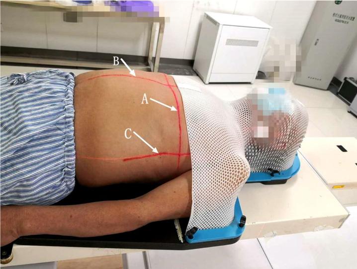 放疗十字线标记图解,放疗身上画的线图片