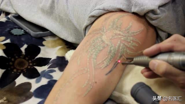 再过18年洗纹身技术会不会变好,纹身的有效洗纹身方法