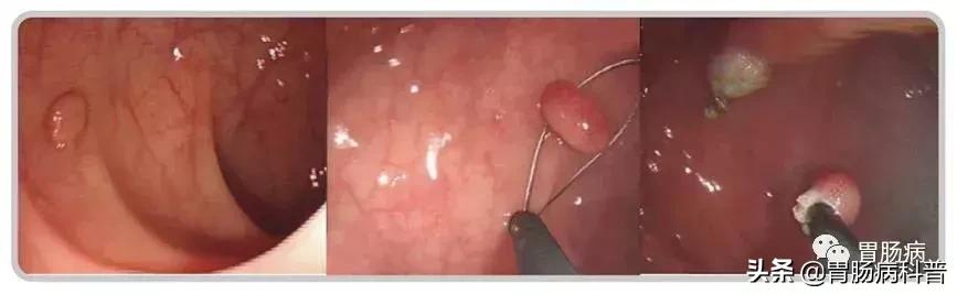 长了胃息肉怎么治疗好,长了胃息肉会有什么症状