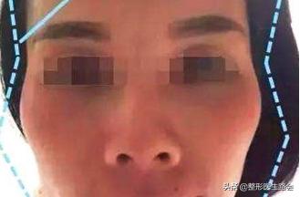 颧骨特别高长胖会不会变好,颧骨高是否特别容易显老