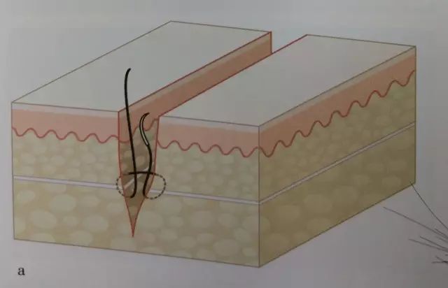 刀口闭合需要多久,伤口闭合除了缝针还有什么方法