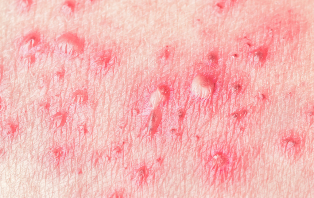 带状疱疹神经痛如何止痛效果最好,治疗疱疹神经痛怎样才可缓解