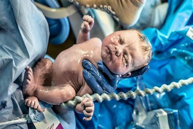 孕中期脐带扭转胎停的原因有哪些,胎儿脐带扭转是怎么回事