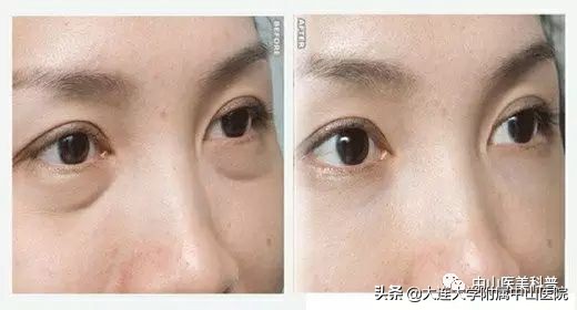 你有没有被自己的眼袋困扰过,关于眼袋的科普在这里