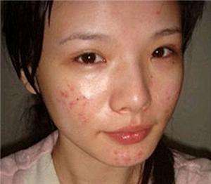 脸上油腻粉刺用什么方法可以解决,满脸粉刺闭口怎么护理