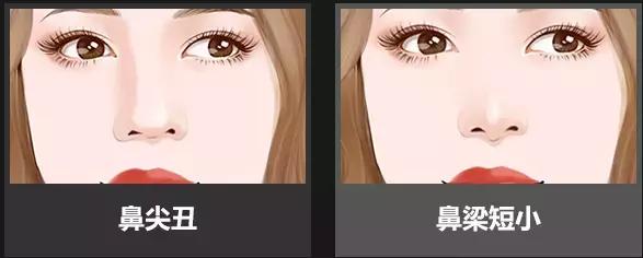 线雕隆鼻的注意事项有哪些,线雕隆鼻多长时间融为一体