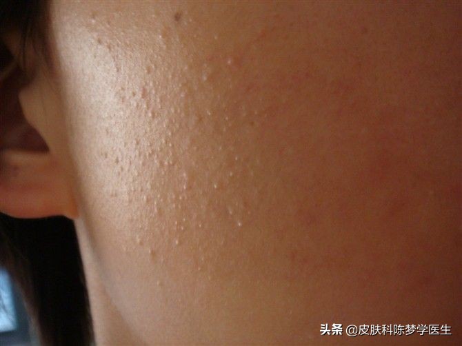 青春痘首选治疗方案是什么？答案都在这里了