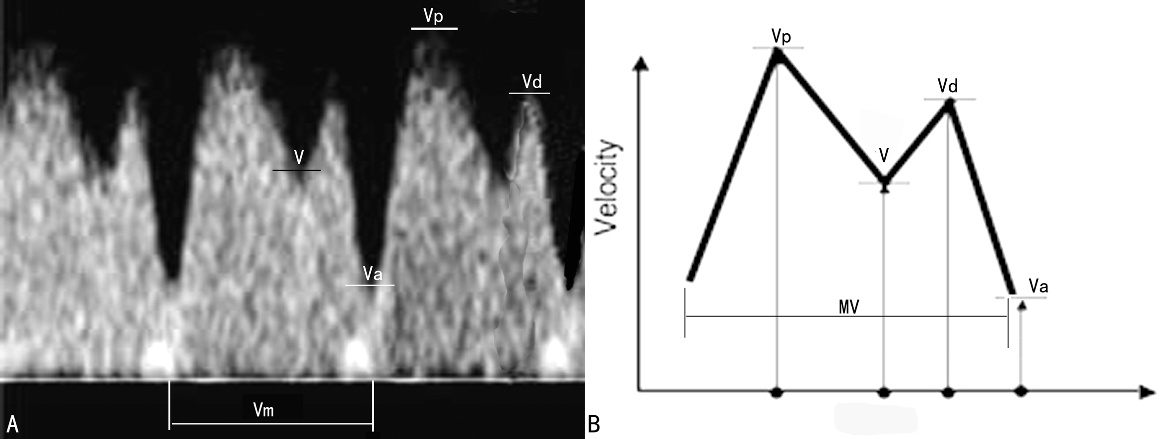 孕期彩色多普勒超声怎么看,多普勒超声检查孕期报告单怎么看