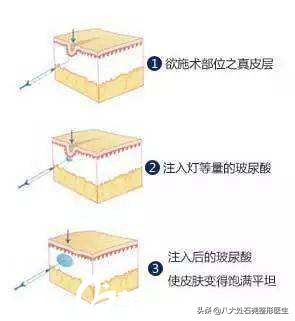 明星太阳穴凹陷怎么解决,太阳穴填充的明星