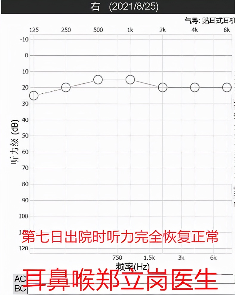 突发性听力下降是什么原因,突发性耳聋针灸后听力下降