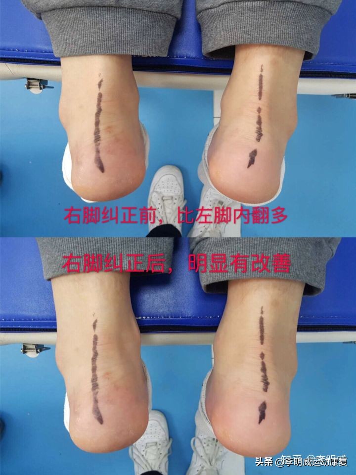 足内翻如何通过调整走路姿势改正,纠正足内翻教你一招