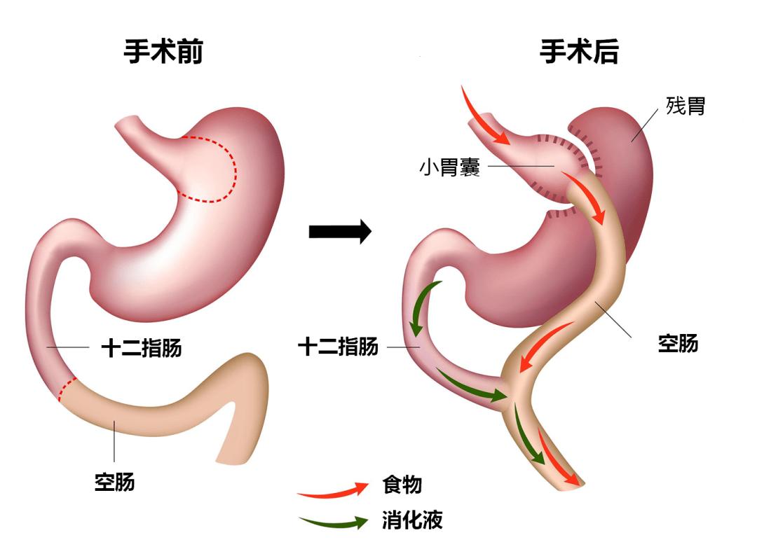 切掉一部分胃可以减肥吗,切掉半个胃能减多少斤