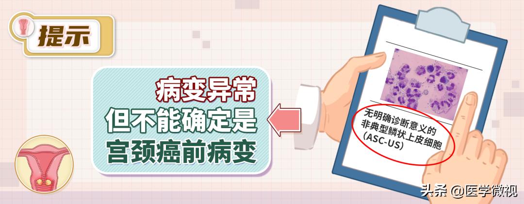 tct和hpv检查哪个确诊宫颈癌,宫颈癌tct检查是什么结果