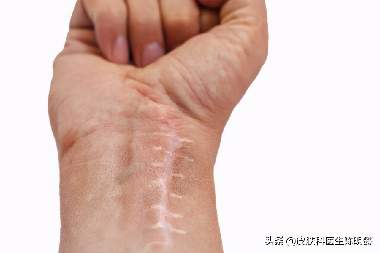 术后瘢痕特别大怎么处置,术后瘢痕形成的原因