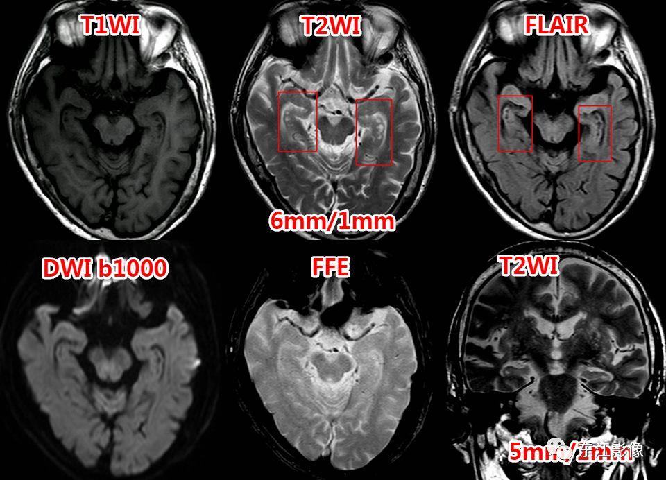 头颅mri扫描影像哪里找,头颅影像mra详细解说