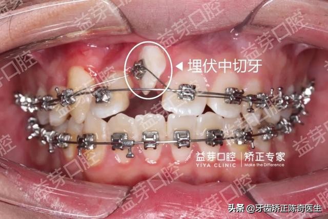 埋伏牙用隐形牙套怎么牵引,龅牙隐形牙套矫正全过程