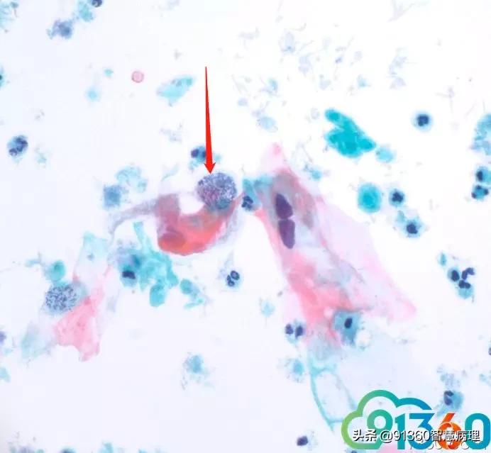 病理宫颈活检lsil是什么意思,宫颈病理检查与tct检查的区别