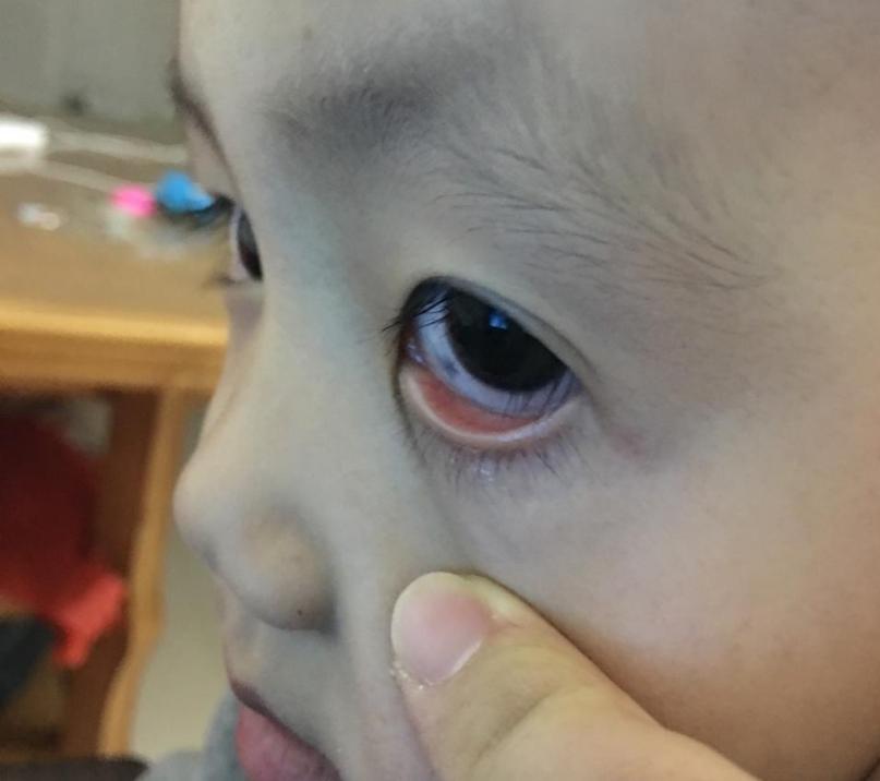 孩子眼白有小黑点是什么原因,儿童眼白有黑点是什么原因