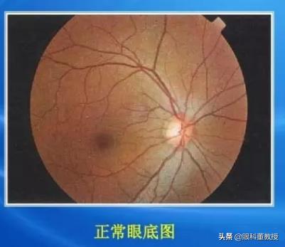 有眼底疾病的朋友福音来了，专家权威科普，后悔没早点看到