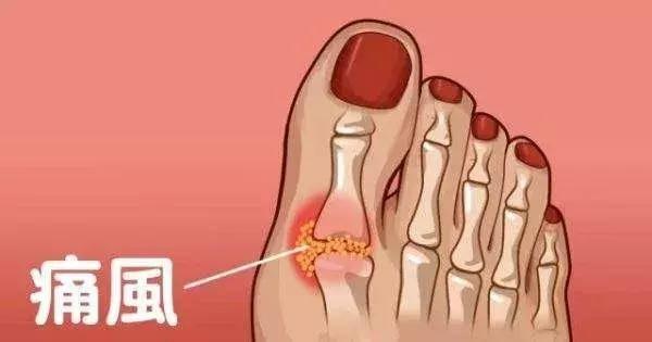 身体出现尿酸有哪些症状,身体出现3种症状尿酸已超标