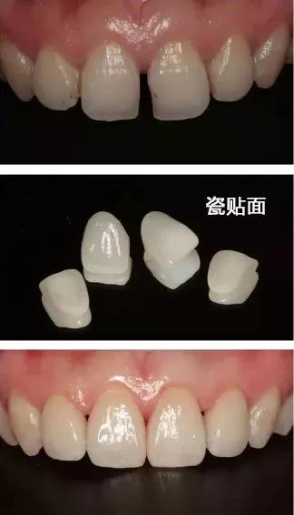 很小的牙缝会恢复吗,牙缝大了能有补救吗