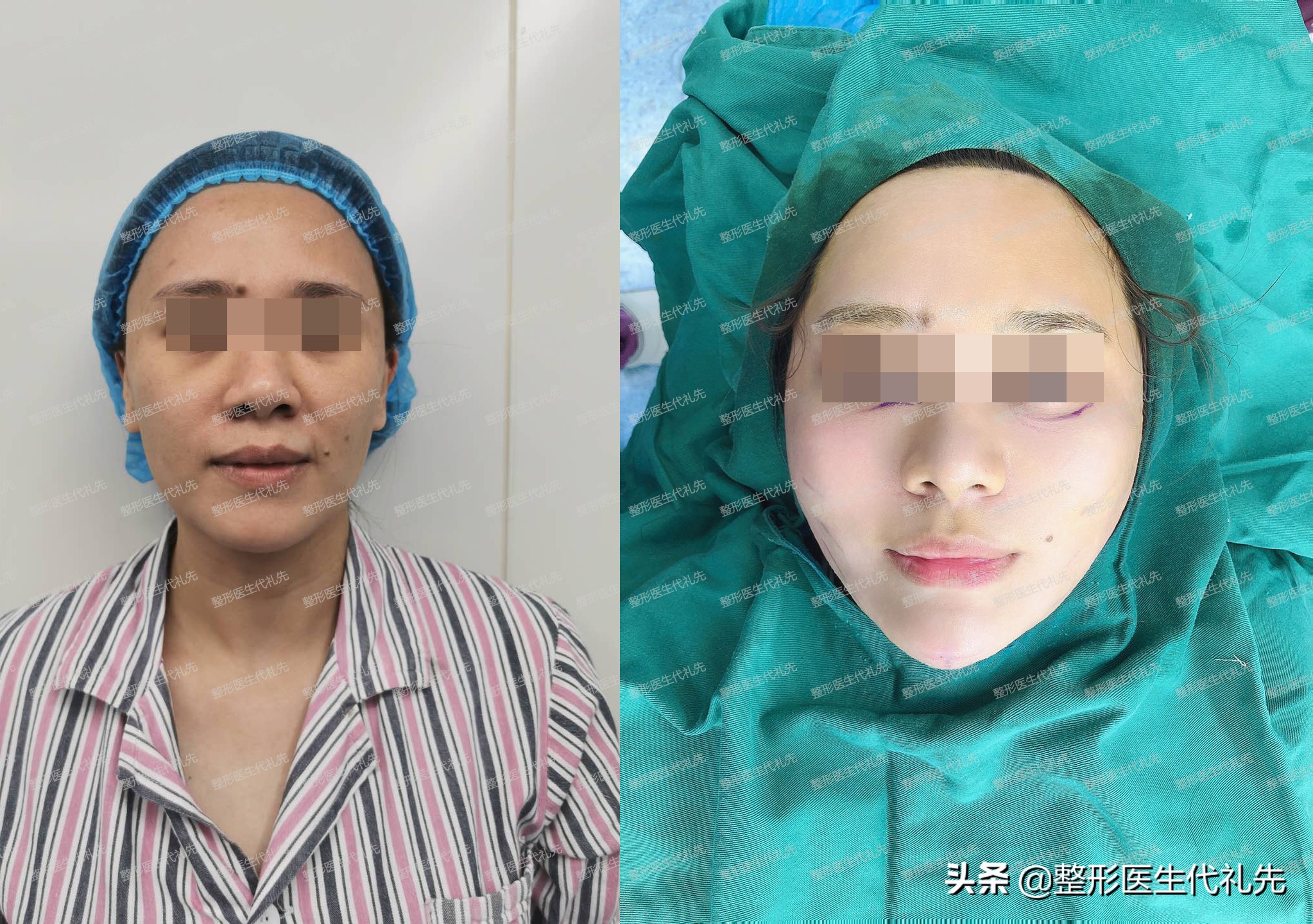 从医学来讲法令纹怎么改善比较好,整形医生怎么解决法令纹的问题