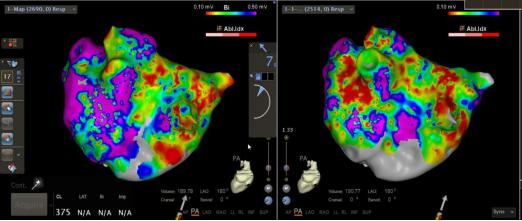 marshall房颤消融术,marshall房颤