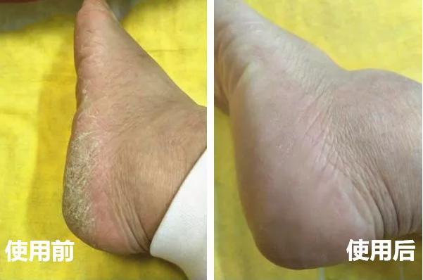 年年入冬脚就干裂有什么方法治好,想长寿养好背