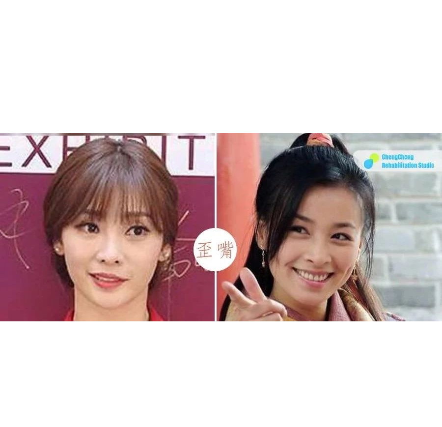 先天性笑起来嘴歪怎么矫正,青少年歪嘴笑怎么矫正