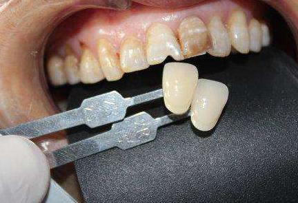 牙周炎松动拔掉再种植好吗,牙齿松动种植什么牙齿好