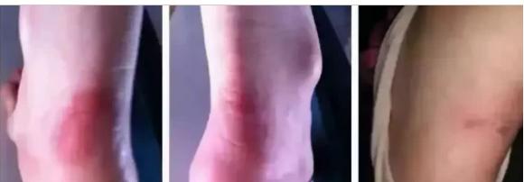 长期没穿高跟鞋脚很容易磨破皮,穿高跟鞋脚后跟磨破皮怎么破解