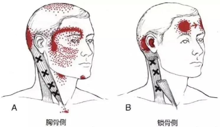 胸锁乳突肌粗大,胸锁乳突肌症状