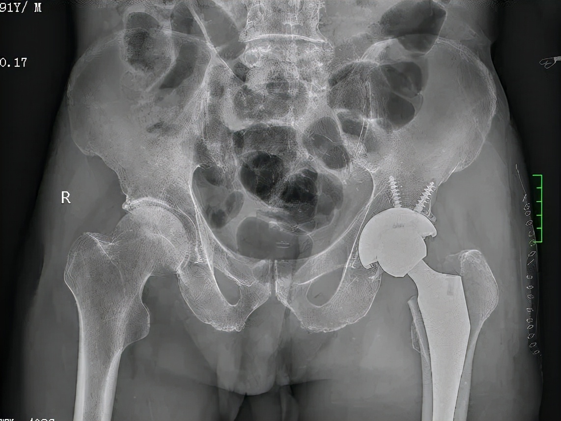 骨质疏松骨折髋关节置换手术,粗隆间骨折需要做髋关节置换吗