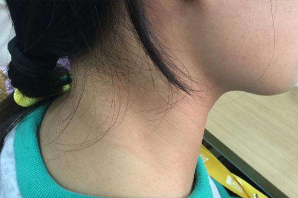 脖子上长小肉粒就一个,脖子上长小肉粒有没有危险