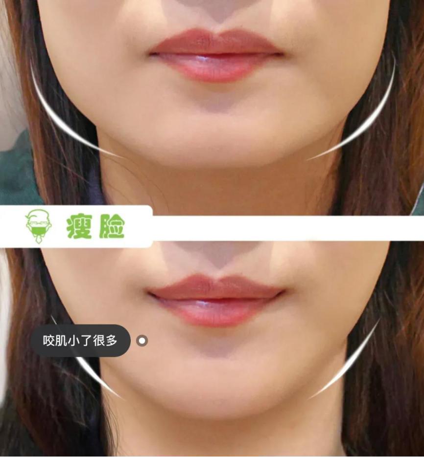 打完瘦脸针多久才是它的最佳效果,为什么打了瘦脸针要一周后才有效