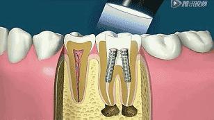 根管治疗第四步骤,根管治疗案例分享话术