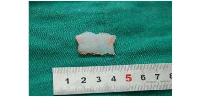 鼻整形案例分享注射隆鼻术,朝天鼻耳软骨假体隆鼻过程