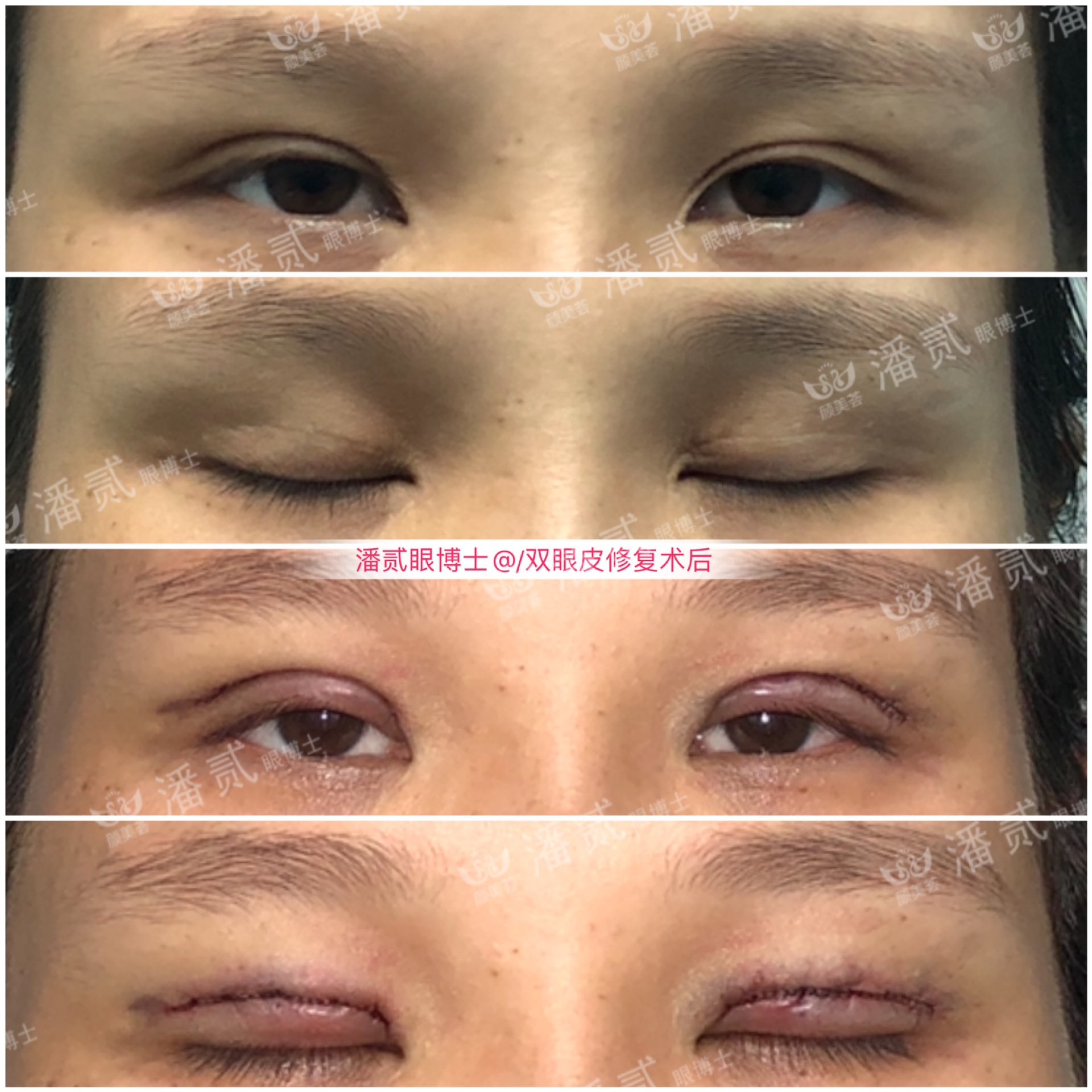 割双眼皮和眉骨有关系吗,做双眼皮想要圆眼割什么样的