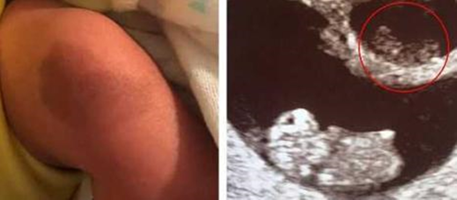 龙凤胎姐姐腹中被“吸收”，B超影像留弟弟腿上，网友：最美胎记