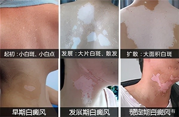 白癜风不治疗,白癜风不治疗有什么危害呢