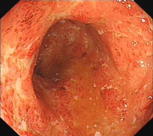 这7种癌症或能治愈,这7种癌都是吃出来的