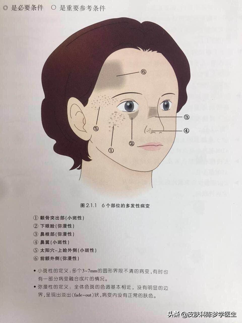 30岁面部斑点越来越多的原因,脸部色斑不及时治疗的图片