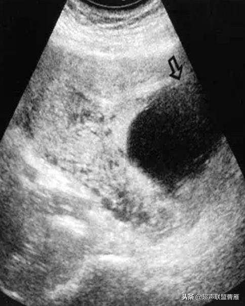 剖宫产疤痕妊娠几率,剖宫产疤痕妊娠及其护理